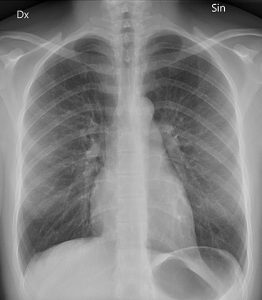 black and white chest-xray. the ribcage, spine, and shoulder girdle are all visible